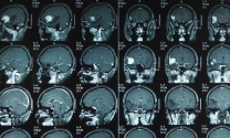 头疼做磁共振能检查出来吗女性怎么治疗的呢