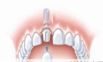 纯钛种植牙可以做核磁共振吗多少钱一颗