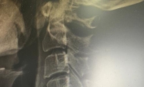 颈椎前路手术钛板固定牢固吗多久能好啊